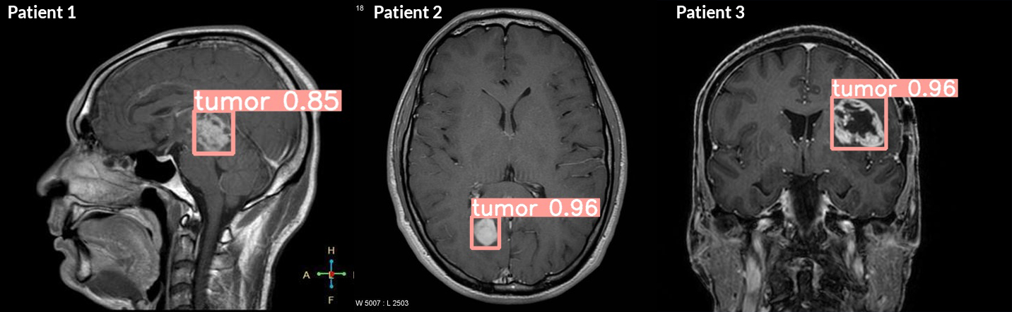 Brain Tumor Prediction